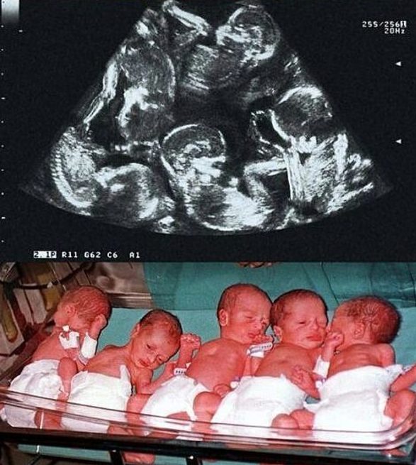 23-year-old mother shocked the world by giving birth to quintuplets that are born every 500 years